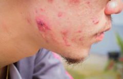 什么原因会长青春痘 长痘原因大揭秘